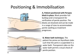 Positioning & Immobilisation
B, Water bath technique. The
patient lies prone on Styrofoam slabs
such that the penis is suspended in a
water bath. Transparent sides on the
water bath permit a visual check of
penile position.
A, Patient positioned with Perspex
block in place. Block provides full
buildup and is transparent for
verification of penile position. The
blocks are bivalved and can be made
in a range of sizes to accommodate
penile swelling as treatment
progresses.
 