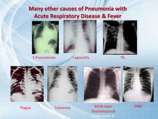 Many other causes of Pneumonia with
Acute Respiratory Disease & Fever
Plague Tularemia RICIN toxin
Staphylococcal
Enterotoxin B
TBLegionella
SARS
S.Pneumoniae
 