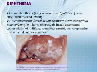 DIPHTHERIA
Classic diphtheria (Corynebacterium diphtheriae): slow
onset, then marked toxicity
Arcanobacterium hemolyticum (formerly Cornyebacterium
hemolyticum): exudative pharyngitis in adolescents and
young adults with diffuse, sometimes pruritic maculopapular
rash on trunk and extremities
 