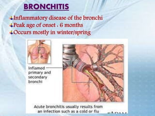 Inflammatory disease of the bronchi
Peak age of onset : 6 months
Occurs mostly in winter/spring
BRONCHITIS
 