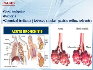 CAUSES:
Viral infection
Bacteria
Chemical irritants ( tobacco smoke, gastric reflux solvents)
 
