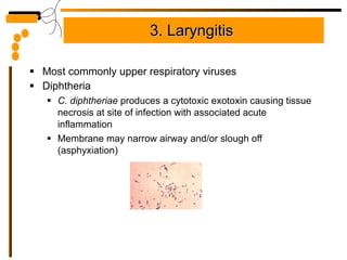 3. Laryngitis  Most commonly upper respiratory viruses Diphtheria  C. diphtheriae  produces a cytotoxic exotoxin causing tissue necrosis at site of infection with associated acute inflammation Membrane may narrow airway and/or slough off (asphyxiation) 
