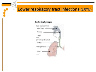 Lower respiratory tract infections  (LRTIs) 