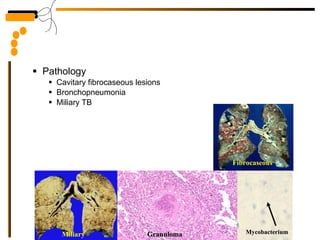 Pathology Cavitary fibrocaseous lesions Bronchopneumonia Miliary TB Miliary Granuloma Fibrocaseous Mycobacterium 