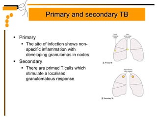 Primary and secondary TB Primary The site of infection shows non-specific inflammation with developing granulomas in nodes Secondary There are primed T cells which stimulate a localised granulomatous response 