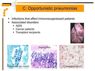 C. Opportunistic pneumonias Infections that affect immunosuppressed patients Associated disorders AIDS Cancer patients Transplant recipients Pneumocystis carinii Aspergillus Cytomegalovirus 
