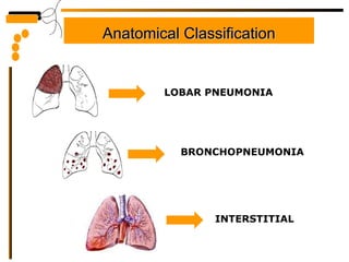 Anatomical Classification LOBAR PNEUMONIA BRONCHOPNEUMONIA INTERSTITIAL 