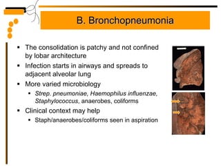 B. Bronchopneumonia The consolidation is patchy and not confined by lobar architecture Infection starts in airways and spreads to adjacent alveolar lung More varied microbiology  Strep. pneumoniae, Haemophilus influenzae, Staphylococcus , anaerobes, coliforms Clinical context may help  Staph/anaerobes/coliforms seen in aspiration 