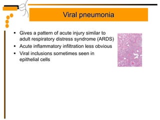 Viral pneumonia Gives a pattern of acute injury similar to adult respiratory distress syndrome (ARDS) Acute inflammatory infiltration less obvious Viral inclusions sometimes seen in epithelial cells 