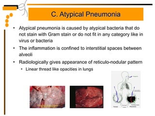 C. Atypical Pneumonia Atypical pneumonia is caused by atypical bacteria that do not stain with Gram stain or do not fit in any category like in virus or bacteria The inflammation is confined to interstitial spaces between alveoli  Radiologically gives appearance of reticulo-nodular pattern Linear thread like opacities in lungs 