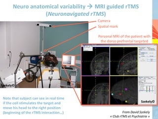 Neuro anatomical variability  MRI guided rTMS
                  (Neuronavigated rTMS)
                                          Camera
                                          Spatial mark

                                          Personal MRI of the patient with
                                           the dorso prefrontal targeted




Szekely©


 Note that subject can see in real time
 if the coil stimulates the target and                           Szekely©
                                                                     Szekely©
                                                                     Szekely©
 move his head to the right position
 (beginning of the rTMS interaction…)                     From David Szekely
                                                 « Club rTMS et Psychiatrie »
 