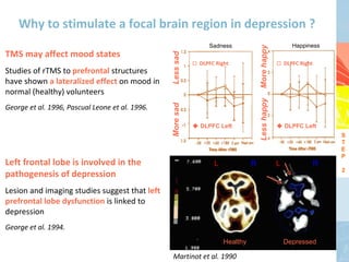 Why to stimulate a focal brain region in depression ?
                                                                  Sadness                               Happiness




                                                                                     More happy
TMS may affect mood states




                                                 Less sad
                                                            ☐ DLPFC Right                         ☐ DLPFC Right
Studies of rTMS to prefrontal structures
have shown a lateralized effect on mood in
normal (healthy) volunteers




                                                                                     Less happy
George et al. 1996, Pascual Leone et al. 1996.




                                                 More sad
                                                             DLPFC Left                           DLPFC Left
                                                                                                                      S
                                                                                                                      T
                                                                                                                      E
                                                                                                                      P
Left frontal lobe is involved in the                               L             R                L               R
                                                                                                                      2
pathogenesis of depression
Lesion and imaging studies suggest that left
prefrontal lobe dysfunction is linked to
depression
George et al. 1994.
                                                                       Healthy                        Depressed

                                                  Martinot et al. 1990
 