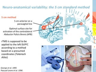 Neuro-anatomical variability: the 5 cm standard method

5 cm method
               5 cm anterior on a
                  parasagital line   5cm

         Optimal surface site for
  activation of the controlateral
   Abductor Policis Brevis (APB)
                                                           S
                                                           T
rTMS is supposed to be                                     E
                                                           P
applied to the left DLPFC
                                                           2
according to a method
based on a presumed
coordinates (Talairach                      45°
Atlas)


George et al. 1995
Pascual Leone et al. 1996
 