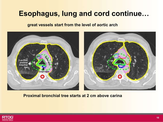 Rtog RTOG 1106 OAR Atlas Thoracic Radiation Therapy.ppt