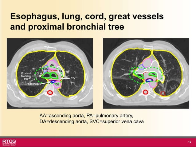 Rtog Rni Atlast RTOG 1106 OAR Atlas Thoracic Radiation Therapy.ppt