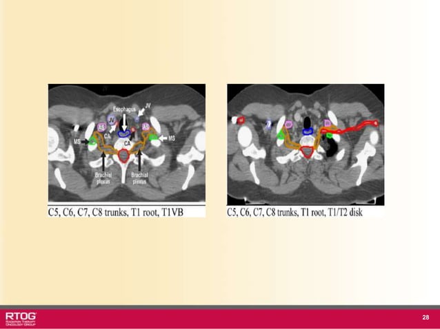 Rtog Rni Atlast RTOG 1106 OAR Atlas Thoracic Radiation Therapy.ppt