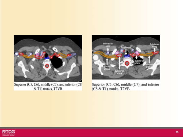 Rtog Rni Atlast RTOG 1106 OAR Atlas Thoracic Radiation Therapy.ppt