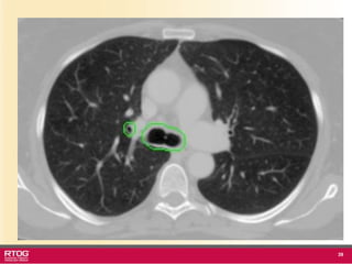 Rtog Rni Atlast RTOG 1106 OAR Atlas Thoracic Radiation Therapy.ppt