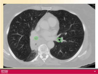 Rtog RTOG 1106 OAR Atlas Thoracic Radiation Therapy.ppt
