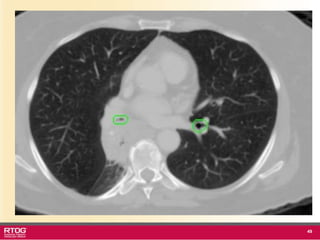 Rtog RTOG 1106 OAR Atlas Thoracic Radiation Therapy.ppt