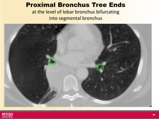 RTOG 1106 OAR Atlas Thoracic Radiation Therapy.ppt