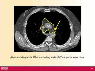 Rtog Rni Atlast RTOG 1106 OAR Atlas Thoracic Radiation Therapy.ppt