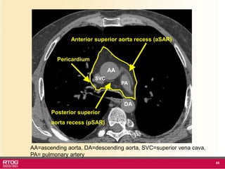 Rtog Rni Atlast RTOG 1106 OAR Atlas Thoracic Radiation Therapy.ppt