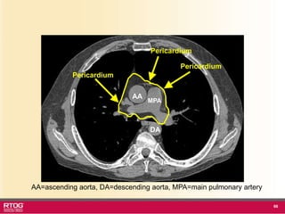 Rtog Rni Atlast RTOG 1106 OAR Atlas Thoracic Radiation Therapy.ppt