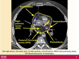 Rtog Rni Atlast RTOG 1106 OAR Atlas Thoracic Radiation Therapy.ppt