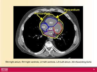 Rtog Rni Atlast RTOG 1106 OAR Atlas Thoracic Radiation Therapy.ppt