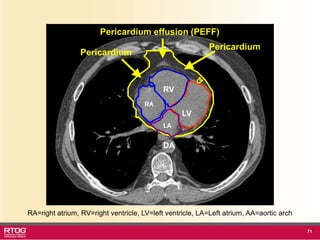 Rtog Rni Atlast RTOG 1106 OAR Atlas Thoracic Radiation Therapy.ppt