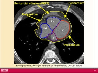 Rtog Rni Atlast RTOG 1106 OAR Atlas Thoracic Radiation Therapy.ppt