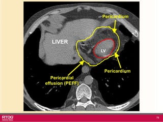 RTOG 1106 OAR Atlas Thoracic Radiation Therapy.ppt