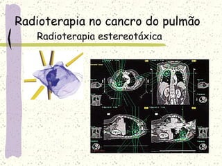 Radioterapia no cancro do pulmão Radioterapia estereotáxica 