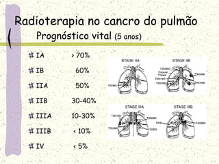 Radioterapia no cancro do pulmão Prognóstico vital  (5 anos) IA > 70% IB   60% IIA   50% IIB 30-40% IIIA 10-30% IIIB  < 10% IV  < 5% 