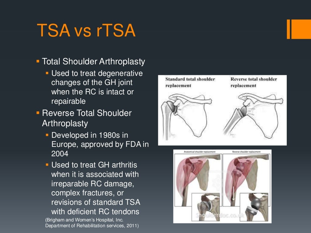 Reverse Total Shoulder Replacement Anatomy, Rehabilitation, and Clin…