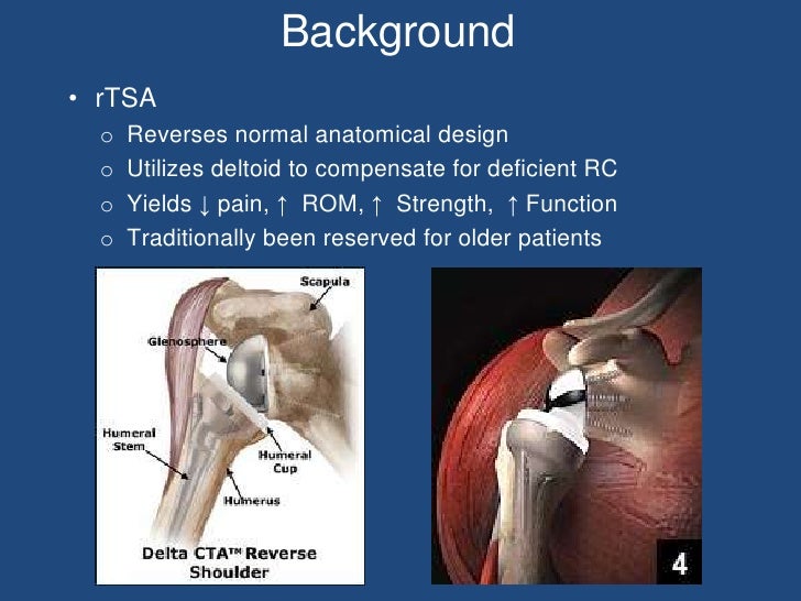 Reverse Total Shoulder Arthroplasty Research Presentation
