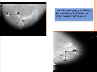 Use of mammography in defining
the boost target localisation in
breast conserving treatment
 