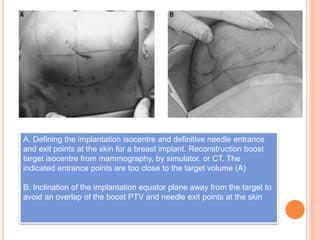 A. Defining the implantation isocentre and definitive needle entrance
and exit points at the skin for a breast implant. Reconstruction boost
target isocentre from mammography, by simulator, or CT. The
indicated entrance points are too close to the target volume (A)
B. Inclination of the implantation equator plane away from the target to
avoid an overlap of the boost PTV and needle exit points at the skin
 