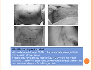 (C). Indication of new entrance and exit points, further away from
the boost CTV, to avoid skin teleangiectases .
(D)Occurrence of severe teleangiectasic ‘stars’ at skin entrance or
exit points if rules for implementation are not followed
Why this planning so important.
With a delivered dose of 50 Gy , chances of late teleangiectasia
may occur in 30% of cases
Vessels may have already received 20–40 Gy from the breast
irradiation. Therefore, there is usually only a small dose amount left
in skin vessel tolerance for teleangiectasia
 