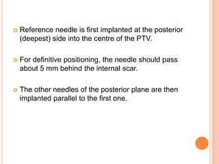  Reference needle is first implanted at the posterior
(deepest) side into the centre of the PTV.
 For definitive positioning, the needle should pass
about 5 mm behind the internal scar.
 The other needles of the posterior plane are then
implanted parallel to the first one.
 