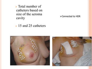 Total number of
catheters based on
size of the seroma
cavity
 15 and 25 catheters
Connected to HDR
 