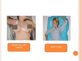 Breast ring with
valecro Alpha cradle
 