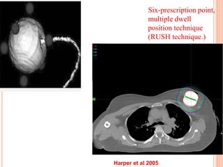 Six-prescription point,
multiple dwell
position technique
(RUSH technique.)
Harper et al 2005
 