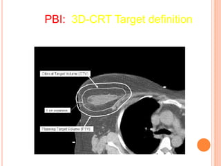 PBI: 3D-CRT Target definition
 
