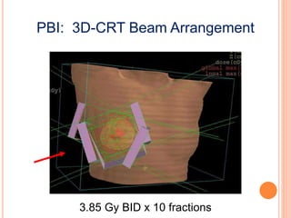 PBI: 3D-CRT Beam Arrangement
3.85 Gy BID x 10 fractions
 