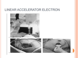LINEAR ACCELERATOR ELECTRON
 