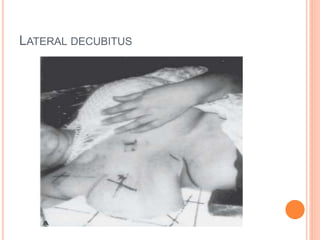 LATERAL DECUBITUS
 