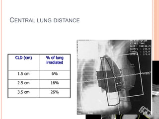 CENTRAL LUNG DISTANCE
CLD (cm) % of lung
irradiated
1.5 cm 6%
2.5 cm 16%
3.5 cm 26%
 