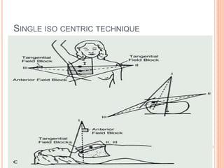 SINGLE ISO CENTRIC TECHNIQUE
 